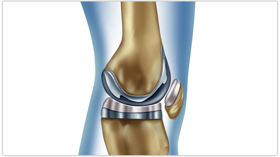 The Conformis custom fits and custom makes every knee replacement for each unique patient, using 3D printing technology