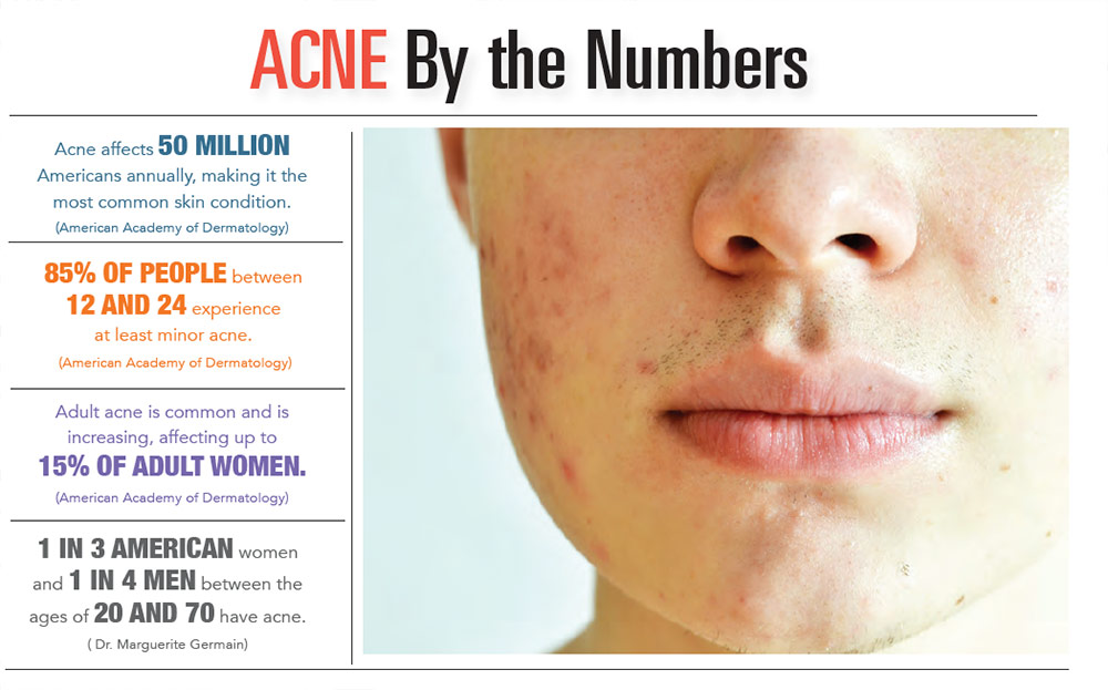 INFOGRAPHIC: Acne by the Numbers