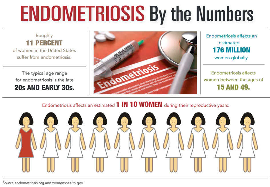 INFOGRAPHIC: Endometriosis by the Numbers