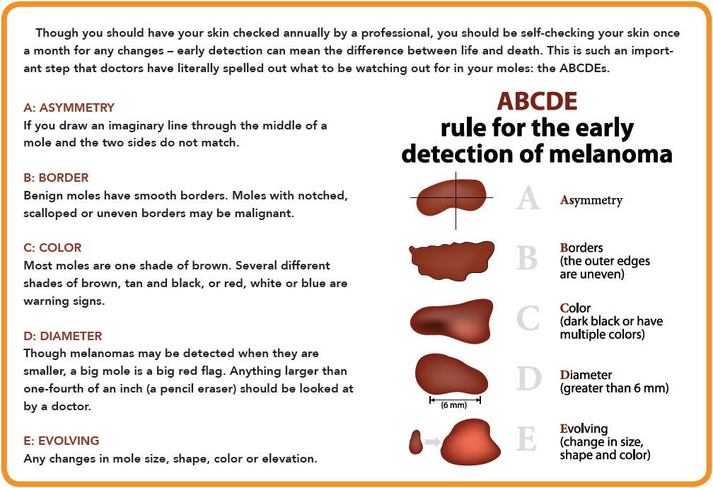 The ABCDE Rule for Early Detection of Melanoma