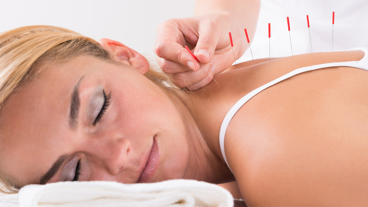 Woman receives acupuncture treatment for pain.