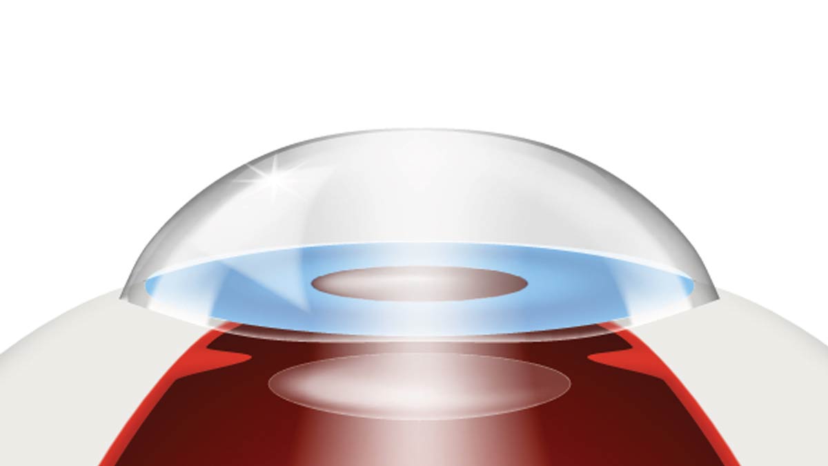 Diagram of eye correction. For Correcting Cataracts is Easy article.