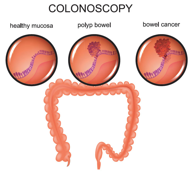 Graphic of a human colon with cross sections showing healthy mucosa, polyp bowel and bowel cancer