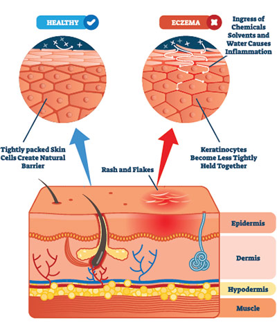 Informational illustration comparing healthy skin VS eczema.