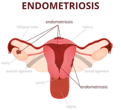 Endometriosis diagram