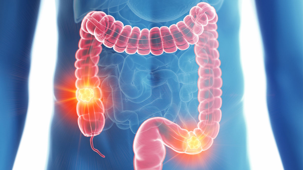 Facts About Colorectal Cancer - HealthLinks SC