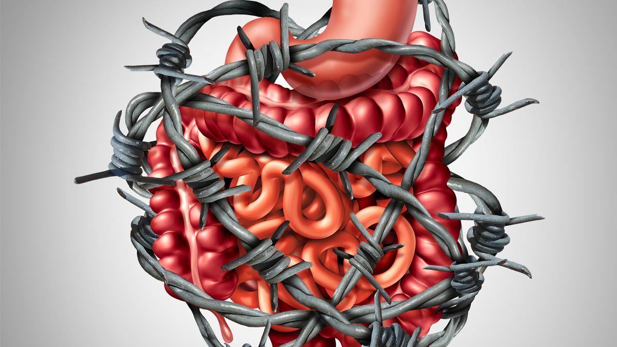 Graphic: IBS pain - the digestive tract in barbed wire