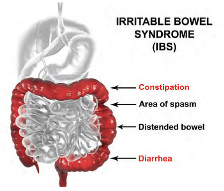 Irritable bowel syndrome graphic showing some symptoms and location of spasms