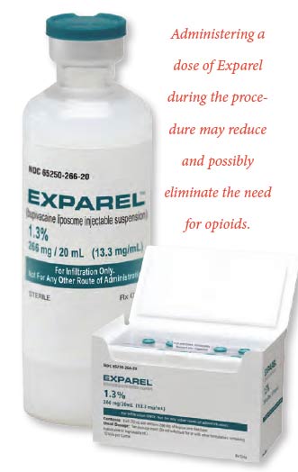 Exparel: Administering a dose of Exparel during the procedure may reduce and possibly eliminate the need for opioids.