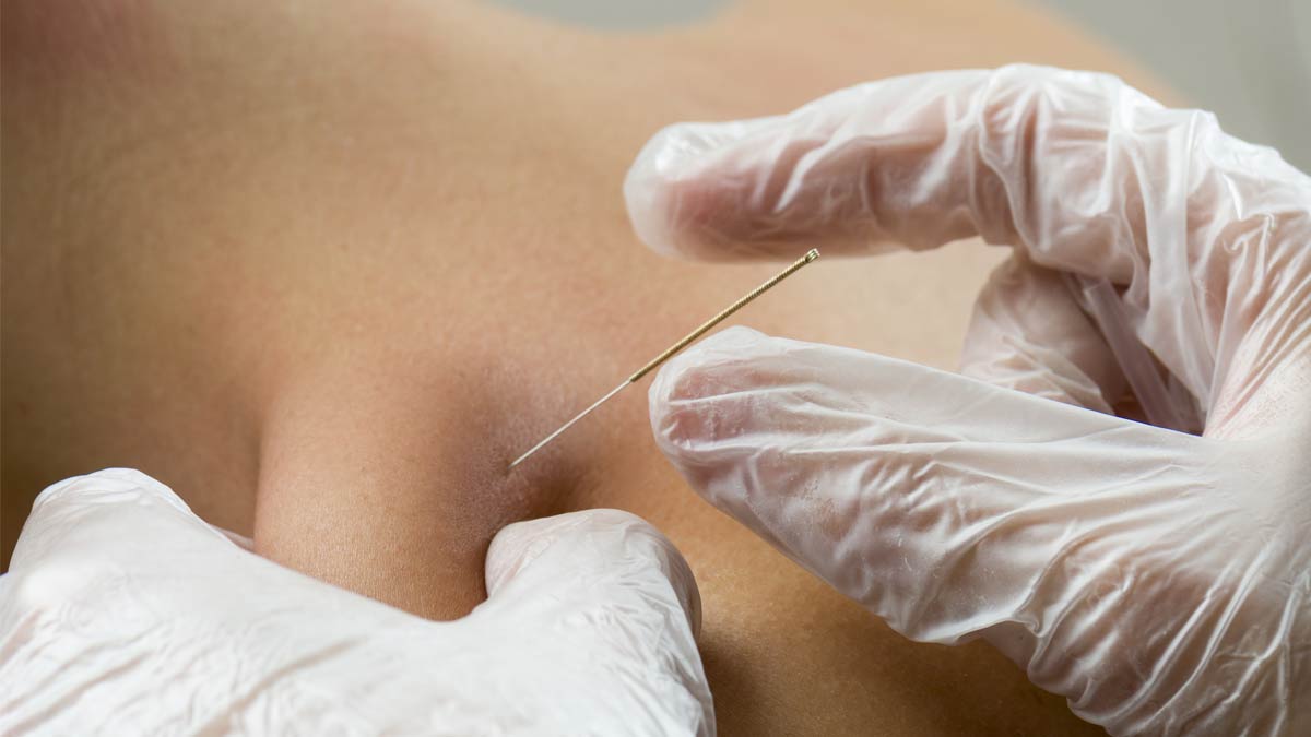 A patient receive dry needling treatment for pain