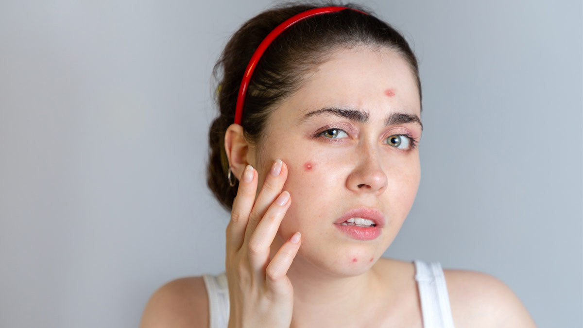 How to Treat Acne - HealthLinks SC