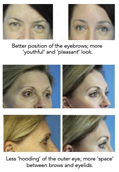 Better position of the eyebrows; more 'youthful' and 'pleasant' look. Less 'hooding' of hte outer eye, more space betweeen brows and eyelids