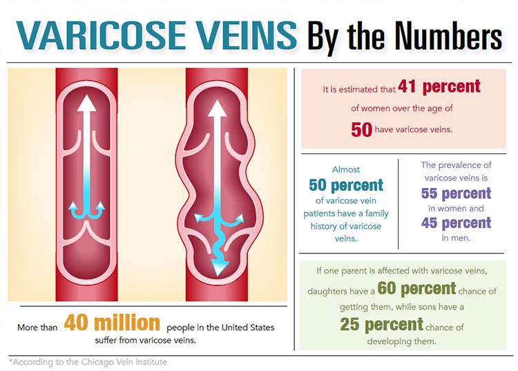 INFOGRAPHIC: Varicose Veins by the Numbers