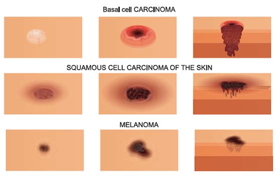 basal cell carcinoma. squamous cell carcinoma of the skin. melanoma