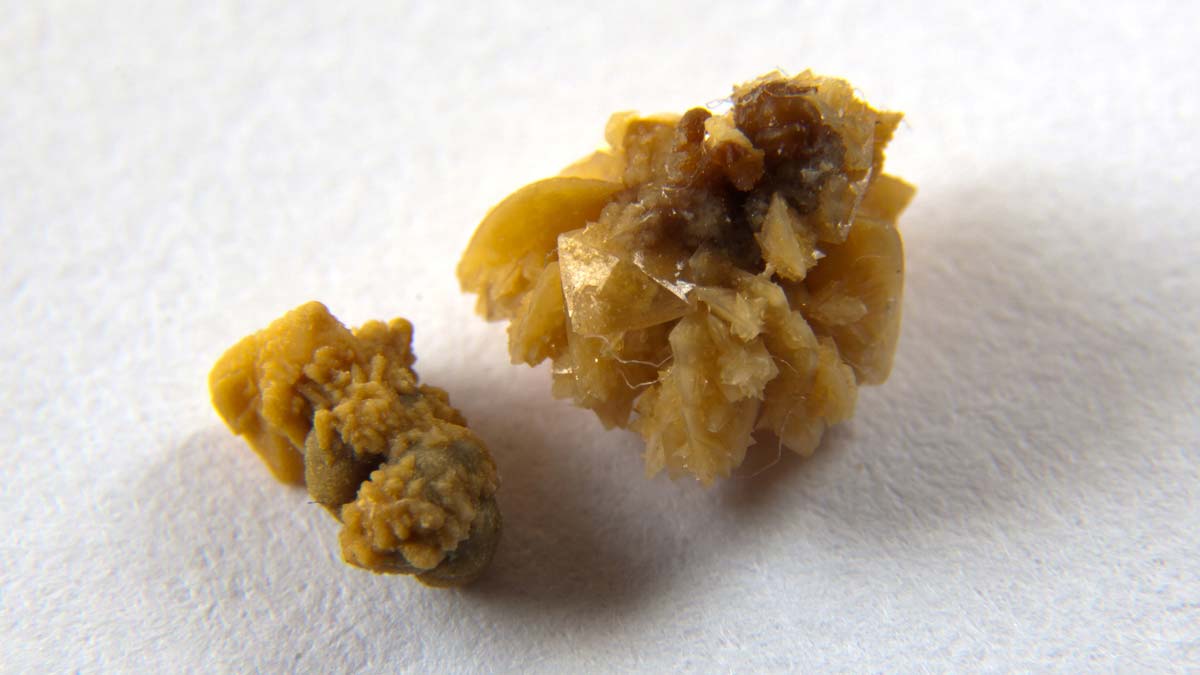 a close up photo of a kidney stone.