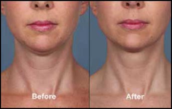 KYBELLA™ BEFORE and AFTER photo