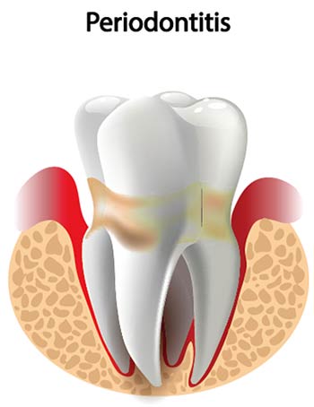 graphic shoing periodontitis (gum disease)