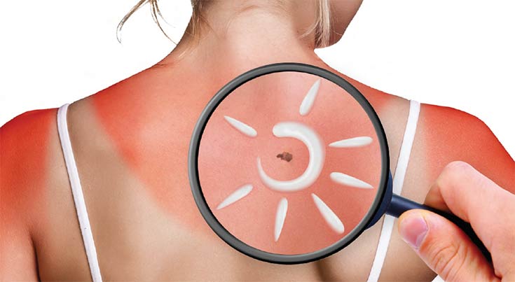 Skin cancer: a growing health risk in the United States