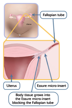 Essure: Diagram of Essure placement