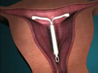 Mirena IUD model, how does Mirena work?