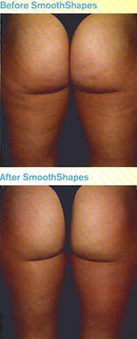 Smooth Shapes before and after photos