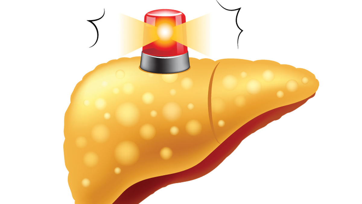 Illustration of a 'liver warning' for the 'NAFLD Has No Symptoms in its Early Stages' article