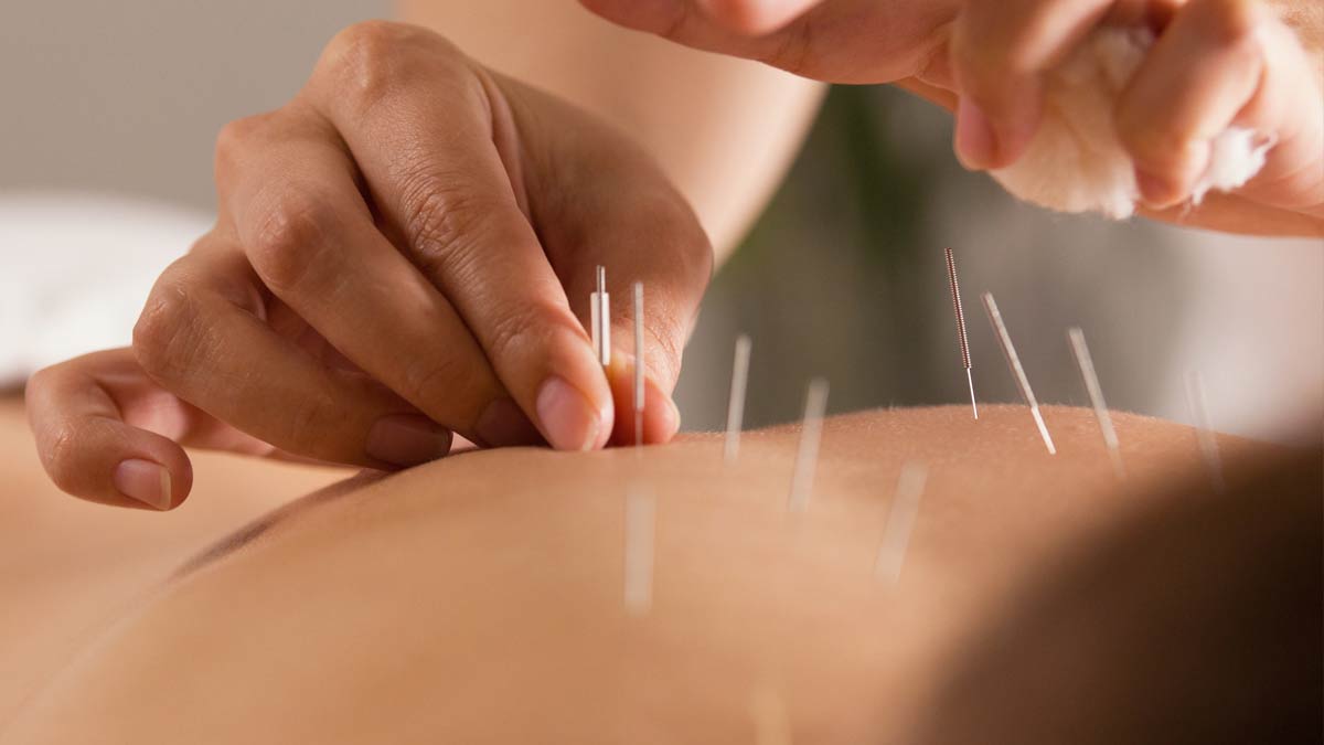 A patient receives a dry needling treatment