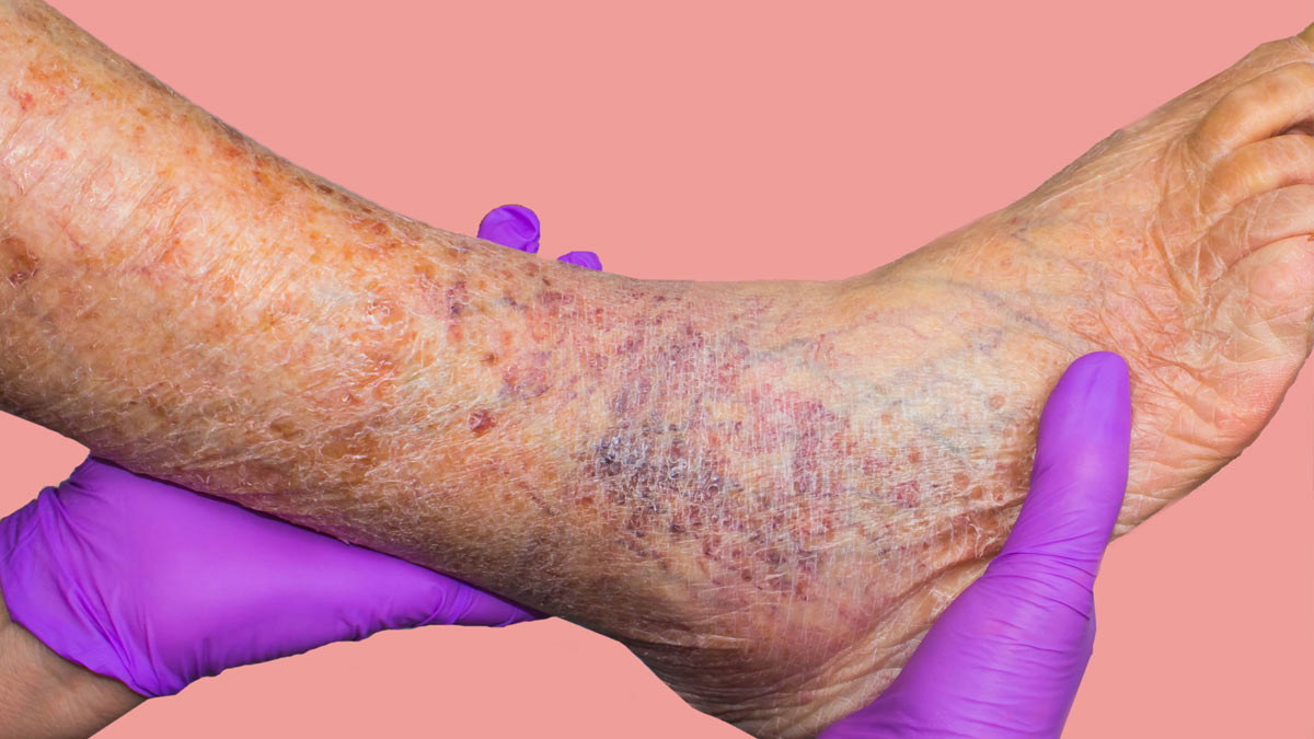 Veins visible on a patient's legs, ankle and foot.