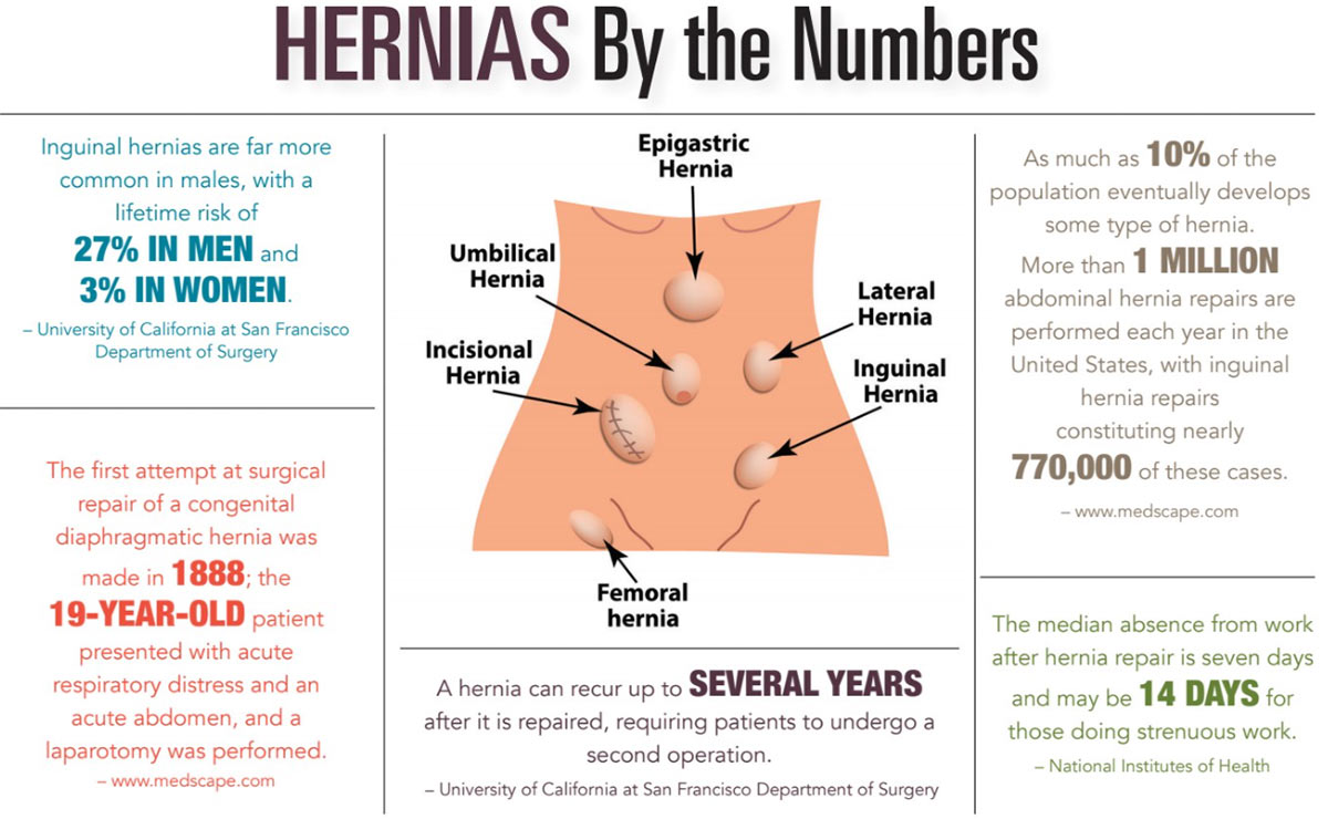 INFOGRAPHIC: Hernias by the Numbers