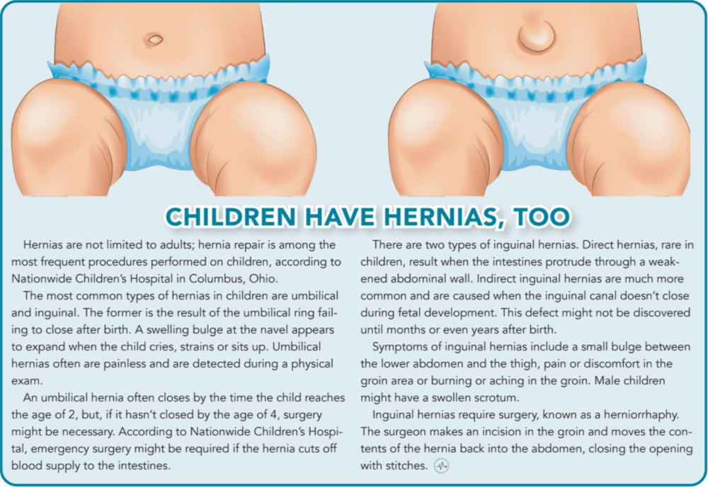 Informative graphic about hernias in children.