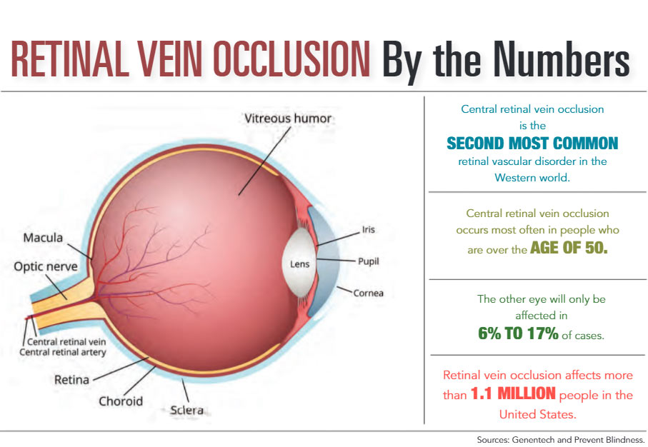 INFOGRAPHIC: Retinal Vein Occlusion by the Numbers.