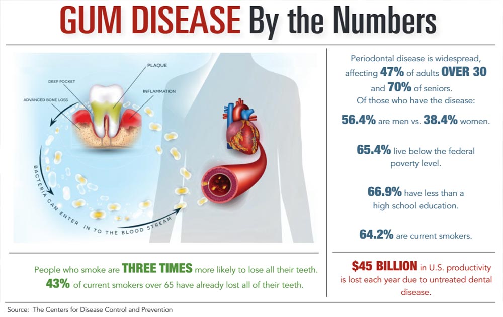 INFOGRAPHIC: Gum Disease by the Numbers