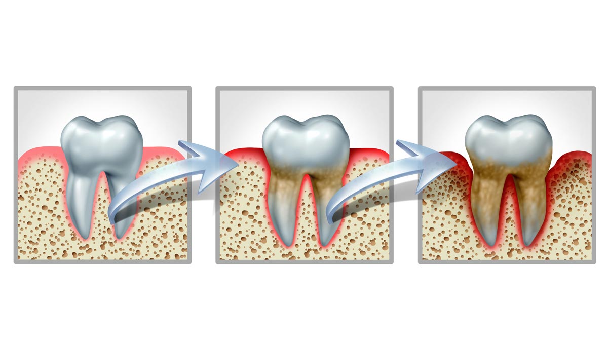 Illustration: progression of gum disease.