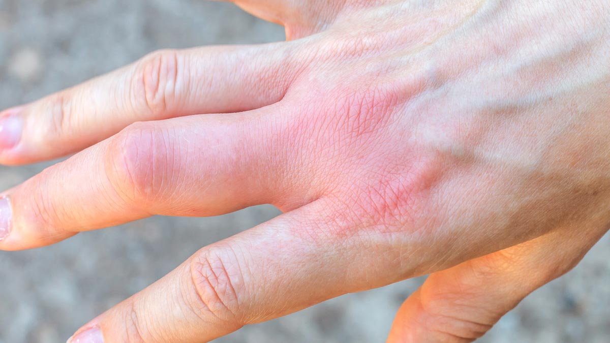 Inflammation of the hand