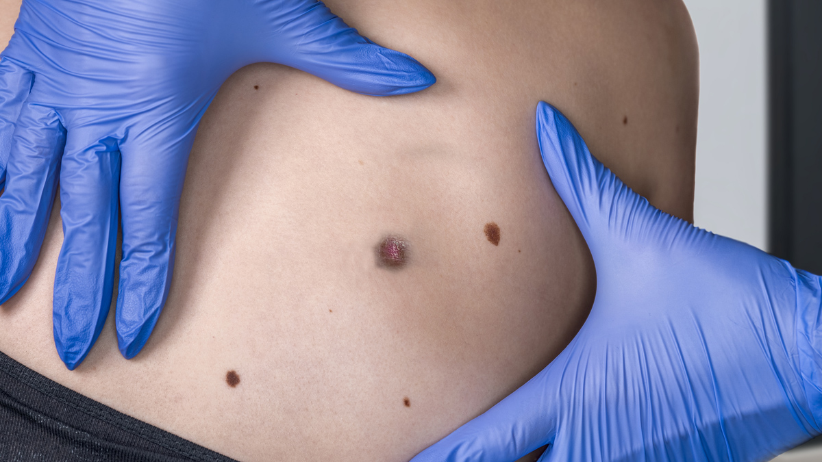 A photo of skin cancer spots on a body