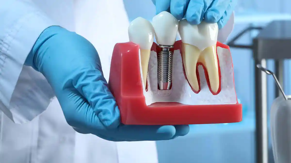 A dentist holding a model of a tooth implant.