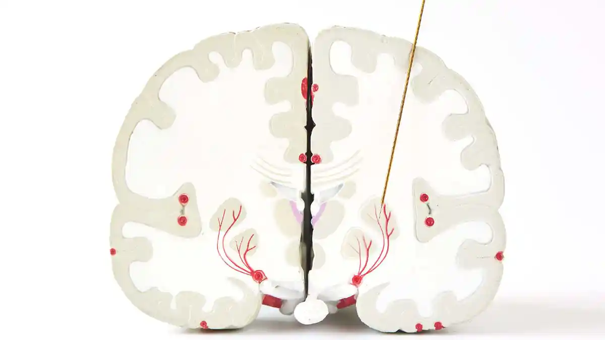 ILLUSTRATION: Deep Brain Stimulation