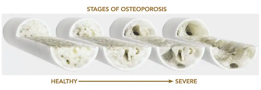 Illustrative graphic depicting the stages of osteoporosis