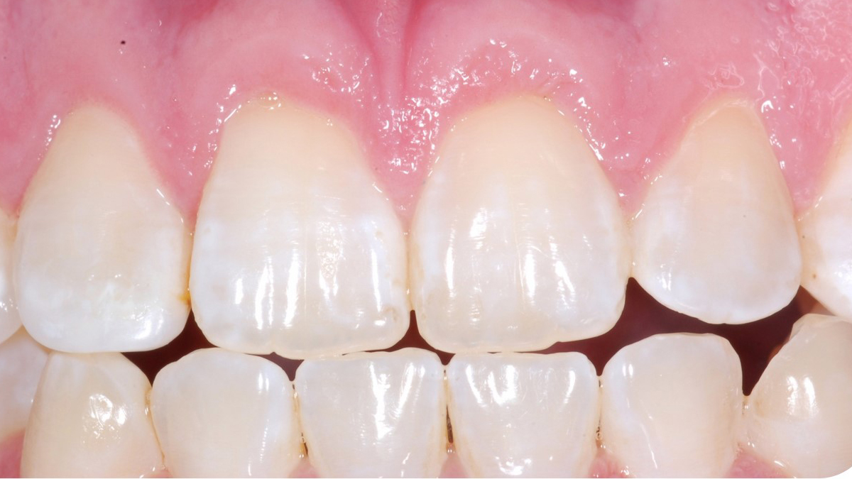 Photo of teeth and gums. Photo provided by Periodontal Associates