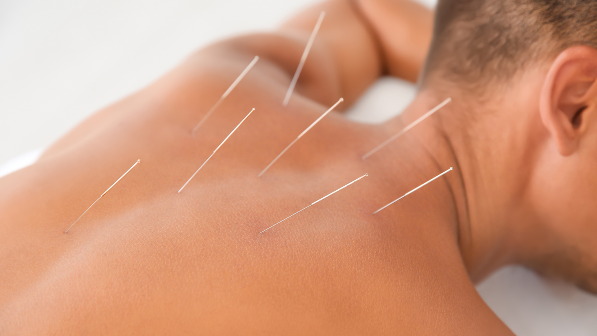 Photo of someone laying down with acupuncture needles in their back