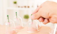 Photo of cupping on a patient